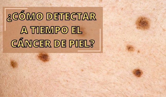 cancer-de-piel-sintomas-fotos cáncer-de-piel-sintomas-fotos