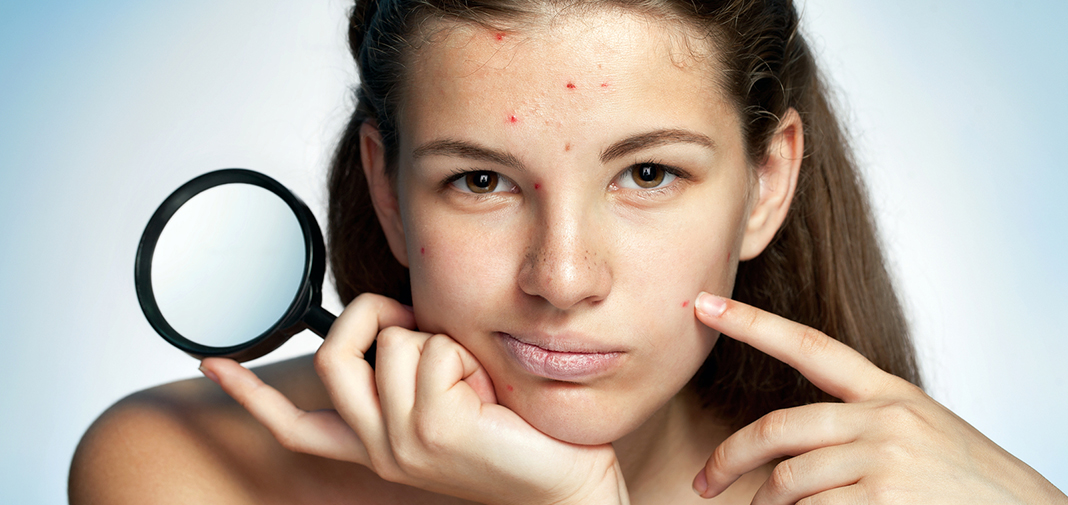 Hábitos y soluciones que pueden ayudar a reducir el acné