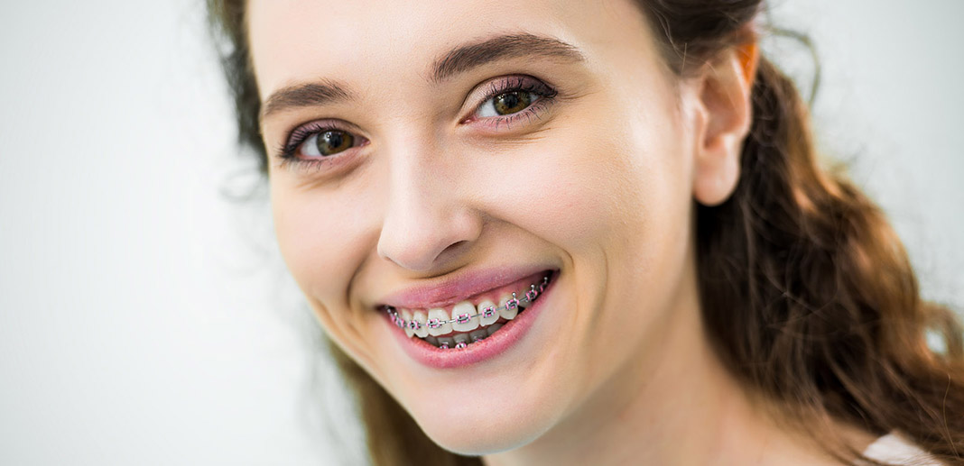 5 beneficios de los frenos dentales